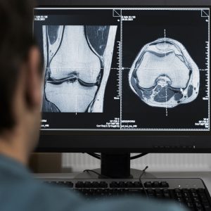 RESONANCIA DE RODILLA SIMPLE